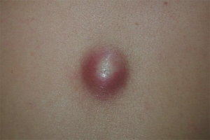  วิธีกำจัด atheroma