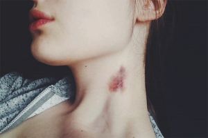  วิธีการกำจัด hickey