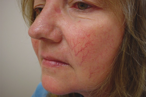  วิธีการรักษา rosacea บนใบหน้า