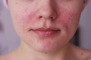  วิธีการกำจัด rosacea บนใบหน้า