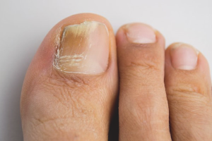  เชื้อรา Toenail