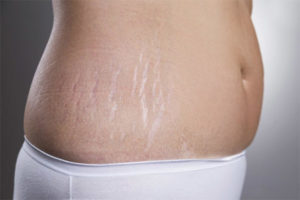  สามารถถอดเครื่องหมายยืดหลังจากคลอดได้หรือไม่
