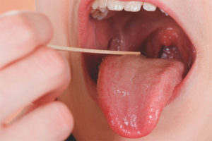  สามารถรักษาอาการเจ็บคอได้โดยไม่ต้องใช้ยาปฏิชีวนะ?